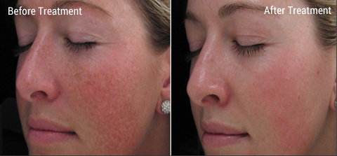 IPL Laser Skin Treatments by Expert Cosmetic Dermatologists