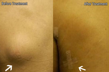 Lipoma Treatment